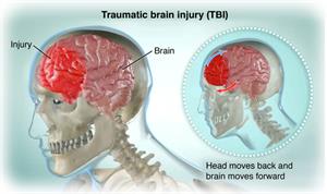  Side view of skull with brain moving forward in the skull, causing a traumatic brain injury (or TBI)