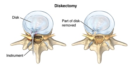 Two top view cross sections, one showing instrument removing herniated portion and the other showing disk after herniated portion is removed.