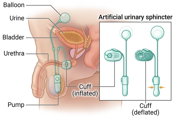 Inner anatomy of the male reproductive system that shows an artificial urinary sphincter attaching by a cuff at the urethra, a pump that falls by the scrotum, and a balloon that sits above the bladder. Call out shows cuff can inflate to squeeze the urethra and make the balloon smaller. Cuff can deflate to create pressure in the pump and make the balloon bigger.